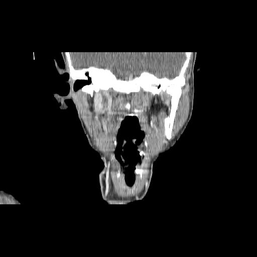 Carcinoma of the maxillary antrum (Radiopaedia 53805-59888 Coronal C+ delayed 91).jpg