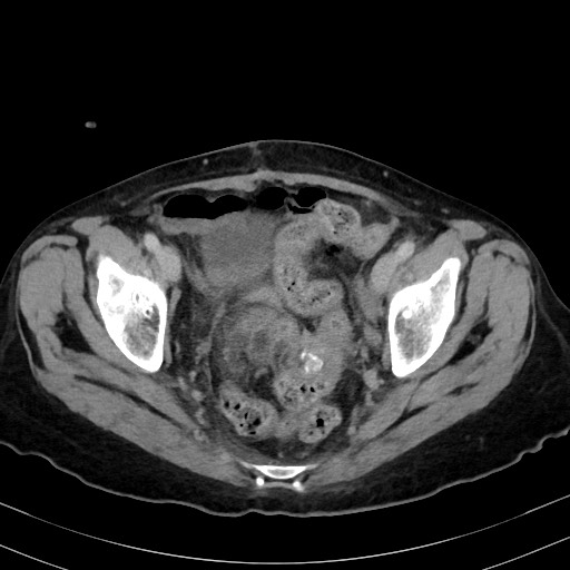 Carcinosarcoma (Radiopaedia 70401-80503 A 58).jpg