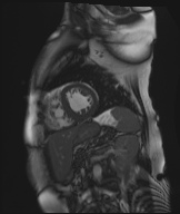 Cardiac amyloidosis (Radiopaedia 51404-57150 Sagittal CINE SSFP 126).jpg
