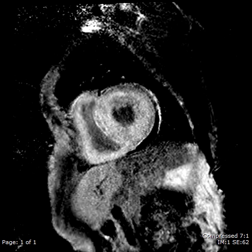 File:Cardiac amyloidosis (Radiopaedia 62017-70102 Short axis - Mid LGE 1).jpg
