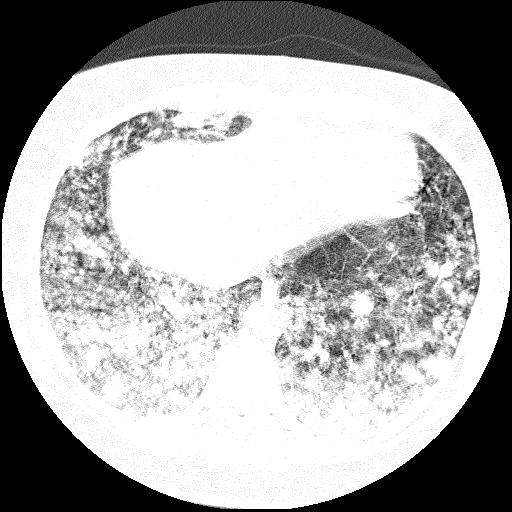Cardiac angiosarcoma (Radiopaedia 66010-75181 Axial lung window 20).jpg