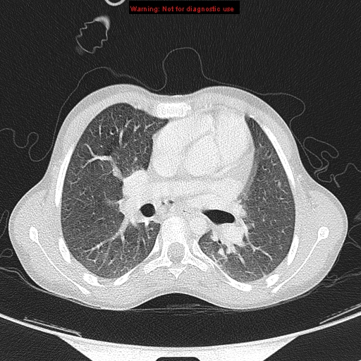 File:Cardiac bronchus (Radiopaedia 14059-13899 A 18).jpg
