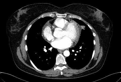 Cardiac sarcoidosis (Radiopaedia 74548-85534 A 50).jpg