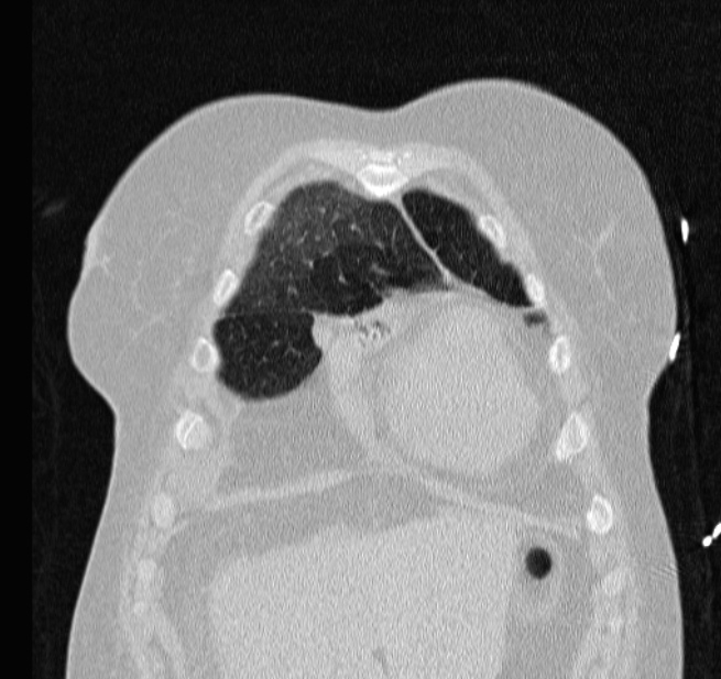 Cardiogenic pulmonary edema (Radiopaedia 29213-29609 Coronal lung window 9).jpg