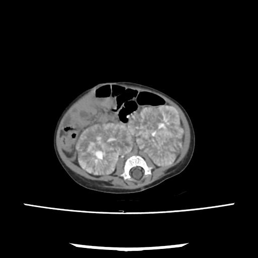 Caroli disease with autosomal recessive polycystic kidney disease (ARPKD) (Radiopaedia 89651-106703 E 147).jpg