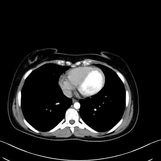 Caroli disease with medullary sponge kidney (Radiopaedia 82622-96804 C 6).jpg