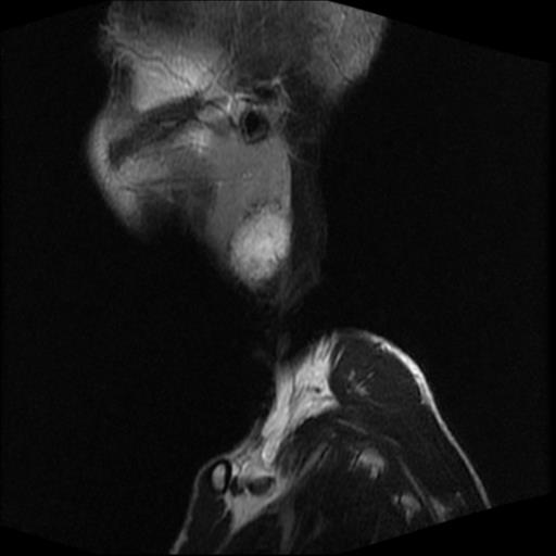 File:Carotid body tumor (Radiopaedia 30208-30823 Sagittal T2 19).jpg