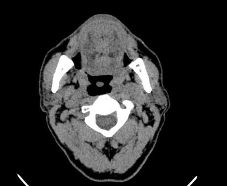 Carotid body tumor (Radiopaedia 61750-69757 Axial non-contrast 28).jpg