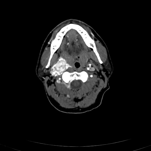 File:Carotid body tumor (Radiopaedia 83615-98727 A 45).jpg