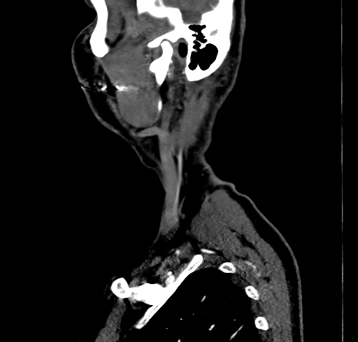 File:Carotid body tumor (Radiopaedia 83615-98727 C 3).jpg