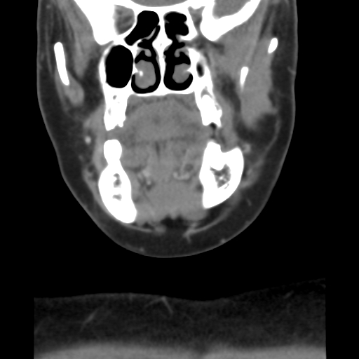 File:Carotid body tumor (paraganglioma) (Radiopaedia 38586-40729 B 12).jpg