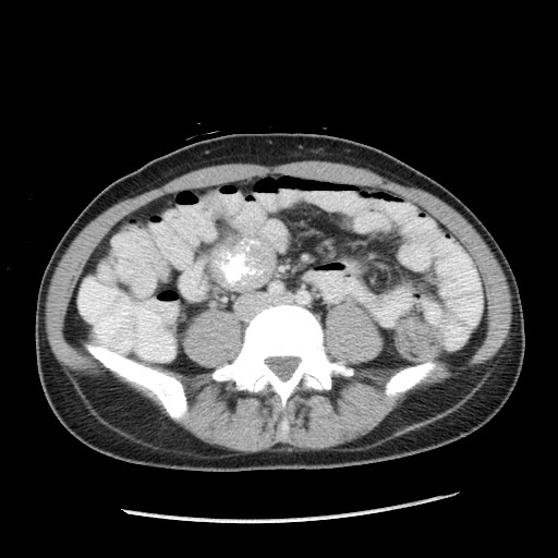 Castleman disease with fibrous pseudotumor in the abdomen (Radiopaedia 77296-89373 A 75).jpg