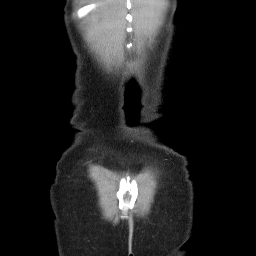File:Castleman disease with fibrous pseudotumor in the abdomen (Radiopaedia 77296-89373 B 89).jpg