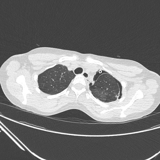 Catamenial pneumothorax (Radiopaedia 27946-28197 lung window 36).jpg