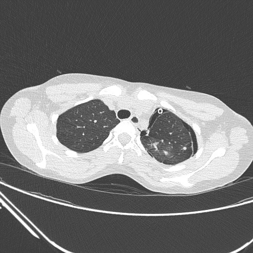 Catamenial pneumothorax (Radiopaedia 27946-28197 lung window 40).jpg