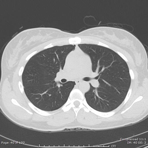 Catamenial pneumothorax (Radiopaedia 54382-60600 Axial non-contrast 40).jpg