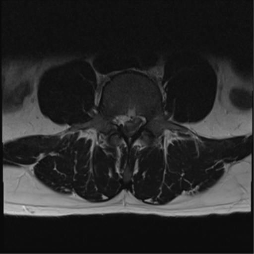 File:Cauda equina syndrome (Radiopaedia 53615-59672 Axial T2 16).png
