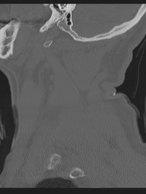 Cavernoma of cervical cord (Radiopaedia 50838-56346 Sagittal bone window 12).png