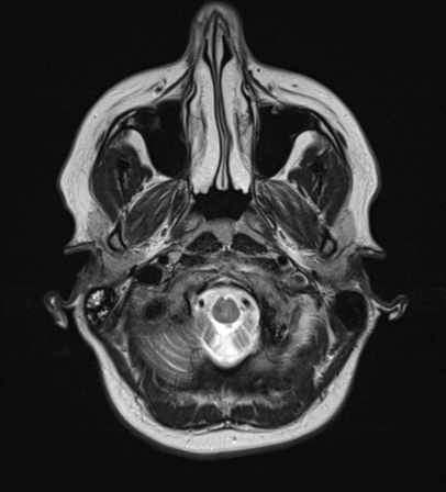 File:Cavernoma with bleed - midbrain (Radiopaedia 54546-60774 Axial T2 2).png