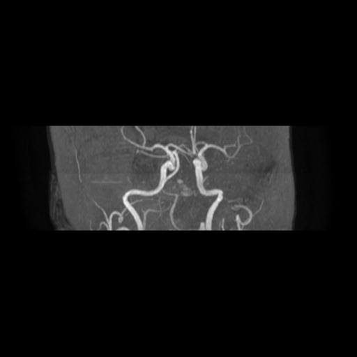 Cavernoma with developmental venous anomaly (Radiopaedia 22470-22507 MRA 12).jpg