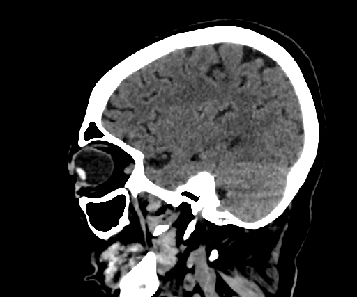 Cavernous hemangioma of the cerebellar falx (Radiopaedia 73025-83723 B 238).jpg