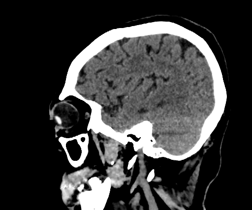 Cavernous hemangioma of the cerebellar falx (Radiopaedia 73025-83723 B 86).jpg