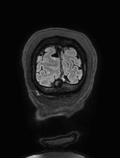 Cavernous hemangioma of the cerebellar falx (Radiopaedia 73025-83724 Coronal FLAIR 338).jpg