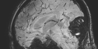 Cavernous hemangioma of the cerebellar falx (Radiopaedia 73025-83724 Sagittal BOLD 99).jpg