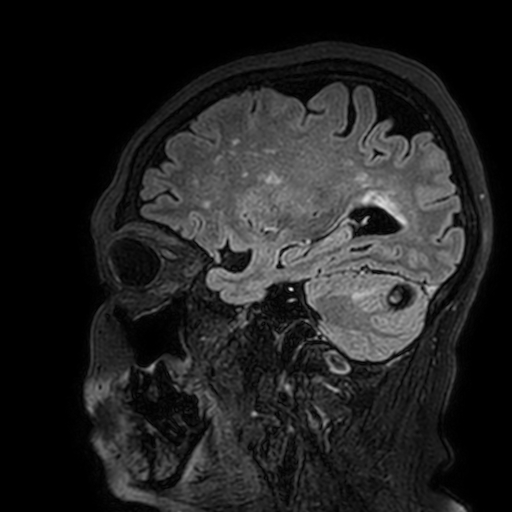 File:Cavernous hemangioma of the cerebellar falx (Radiopaedia 73025-83724 Sagittal FLAIR 155).jpg
