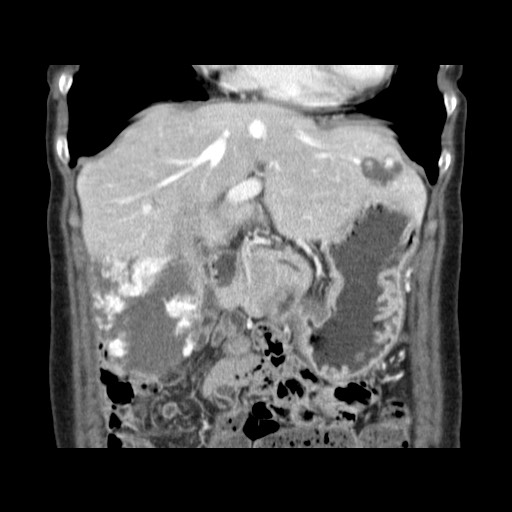 Cavernous hepatic hemangioma (Radiopaedia 75441-86667 C 47).jpg