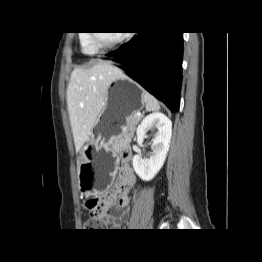 Cavernous hepatic hemangioma (Radiopaedia 75441-86667 D 140).jpg