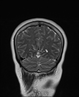File:Cavernous sinus meningioma (Radiopaedia 63682-72367 Coronal T2 18).jpg