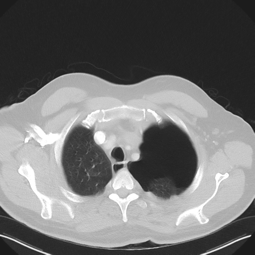 File:Cavitating pneumonia complicated by pneumothorax (Radiopaedia 48149-52994 Axial lung window 12).png