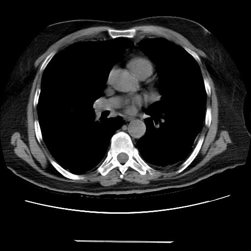 Cavitating pulmonary metastases (Radiopaedia 89545-106544 Axial non-contrast 30).jpg