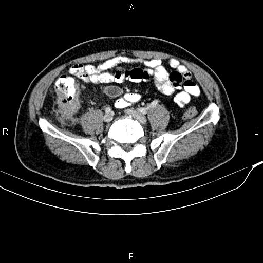 Cecal cancer with appendiceal mucocele (Radiopaedia 91080-108651 B 73).jpg