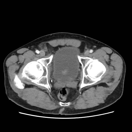 Cecal mass causing appendicitis (Radiopaedia 59207-66531 A 83).jpg