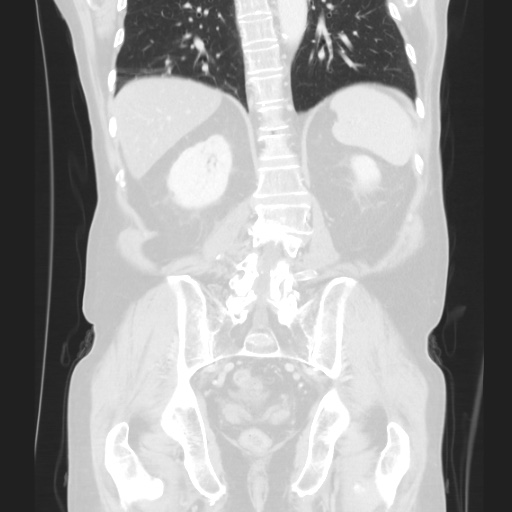 Cecal volvulus (Radiopaedia 75378-86620 Coronal lung window 99).jpg