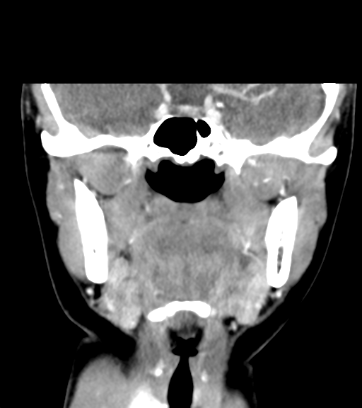 Cemento-ossifying fibroma (Radiopaedia 46243-50643 Coronal C+ delayed 32).png