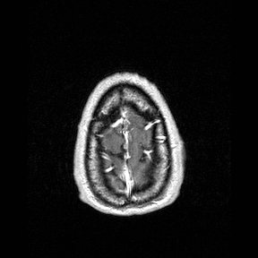File:Central-variant posterior reversible encephalopathy syndrome (PRES) (Radiopaedia 43880-47358 Axial T1 C+ 160).jpg