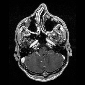 Central-variant posterior reversible encephalopathy syndrome (PRES) (Radiopaedia 43880-47358 Axial T1 C+ 27).jpg