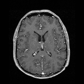 Central-variant posterior reversible encephalopathy syndrome (PRES) (Radiopaedia 43880-47358 Axial T1 C+ 93).jpg