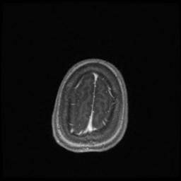 Central neurocytoma (Radiopaedia 30220-30842 Axial T1 C+ 137).jpg