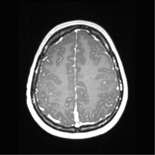 Central neurocytoma (Radiopaedia 37664-39557 Axial T1 C+ 62).png