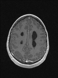 Central neurocytoma (Radiopaedia 56690-63469 Axial T1 C+ 127).jpg
