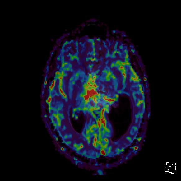Central neurocytoma (Radiopaedia 84497-99872 Axial Perfusion 170).jpg