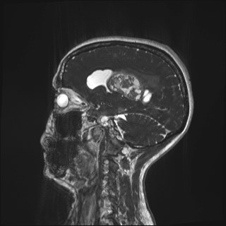 File:Central neurocytoma (Radiopaedia 84497-99872 Sagittal CISS 22).jpg