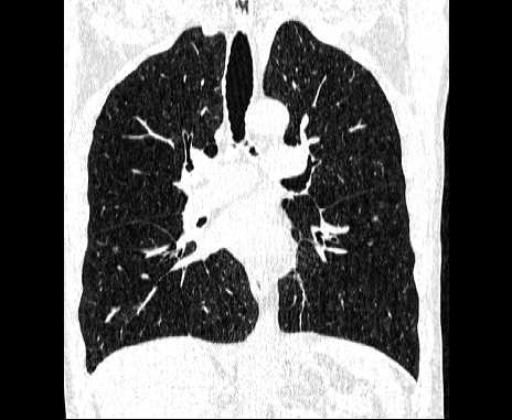 Centrilobular pulmonary emphysema (Radiopaedia 62468-70718 Coronal lung window 39).jpg