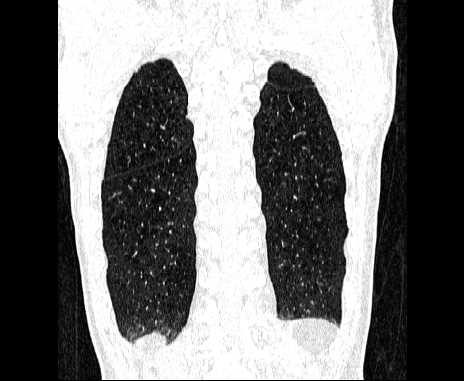 Centrilobular pulmonary emphysema (Radiopaedia 62468-70718 Coronal lung window 63).jpg