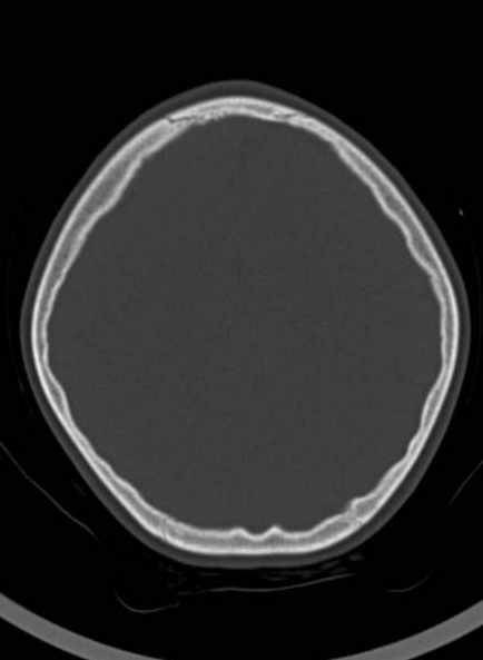 Cerebellar abscess (Radiopaedia 73727-84527 Axial bone window 51).jpg