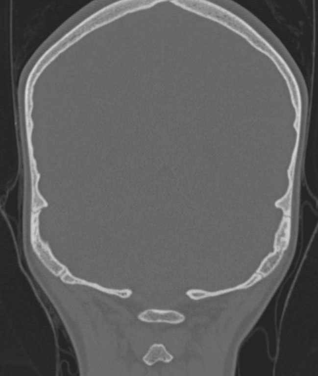 Cerebellar abscess (Radiopaedia 73727-84527 Coronal bone window 6).jpg